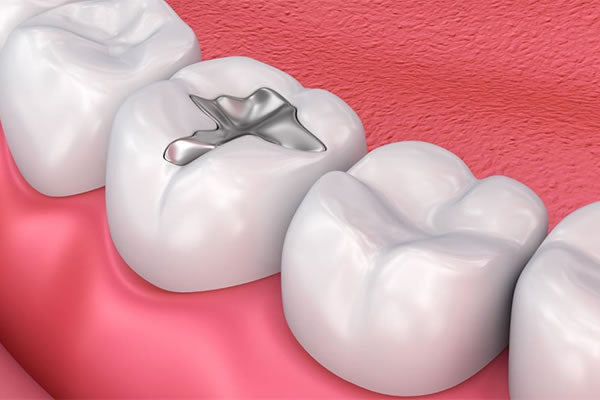 Dental Filling