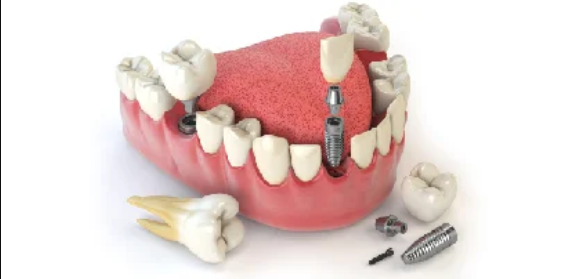 Dental Implant