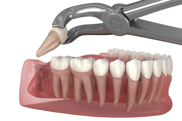 Wisdom Tooth Extraction