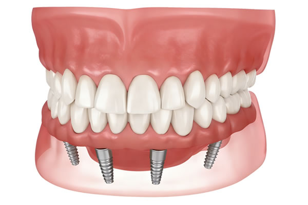 All-On-4 Implants (1 Jaw)