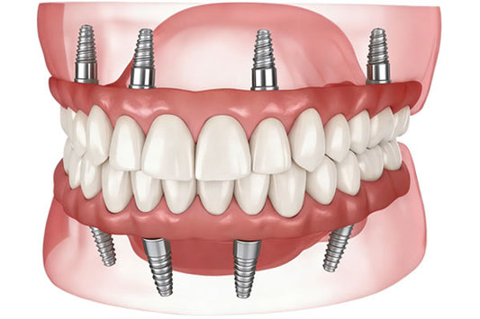 Full Mouth All-On-4 Implants Package(2 Jaws)
