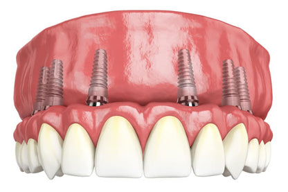 Full Mouth All-On-6 Implants Package(1 Jaws)