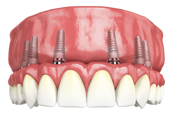 All-On-6 Implants (1 Jaw)