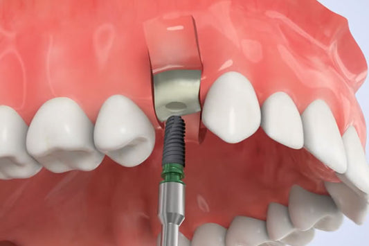 Dental Implant
