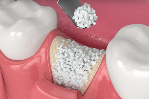 Bone Graft