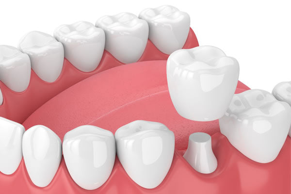 Dental Crowns
