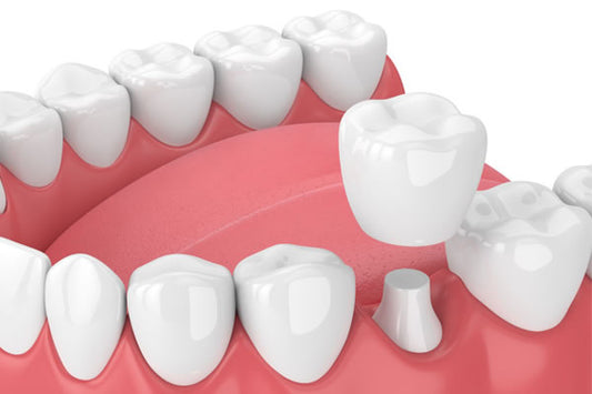 Dental Crowns