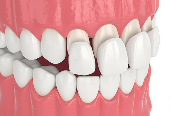 Porcelain Veneer