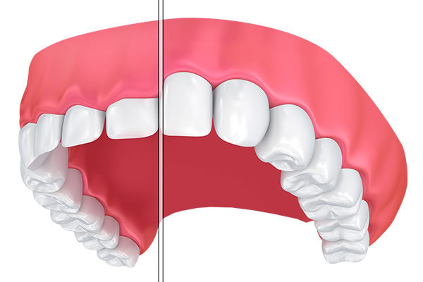 Gum Contouring