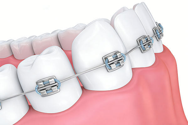 Orthodontic Braces