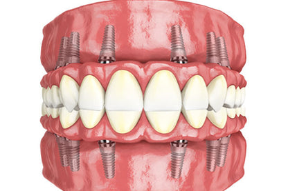 Full Mouth All-On-6 Implants Package(2 Jaws)
