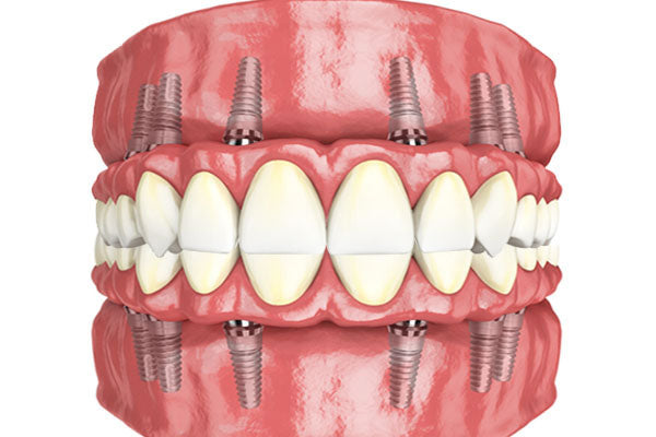 All-On-6 Implants (2 Jaws)