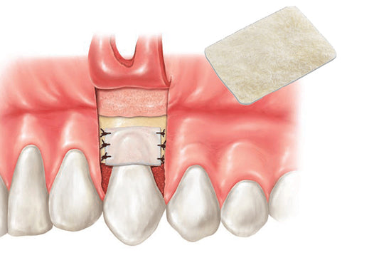 Absorbable Membranes