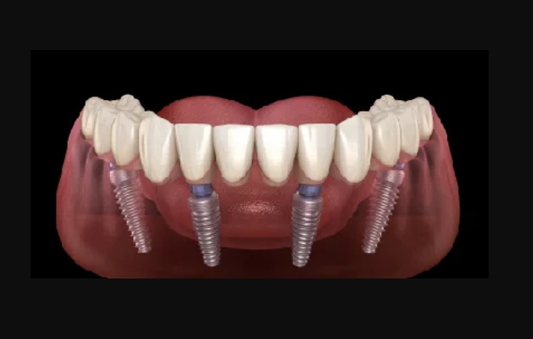 All On 4 (1 Jaw)