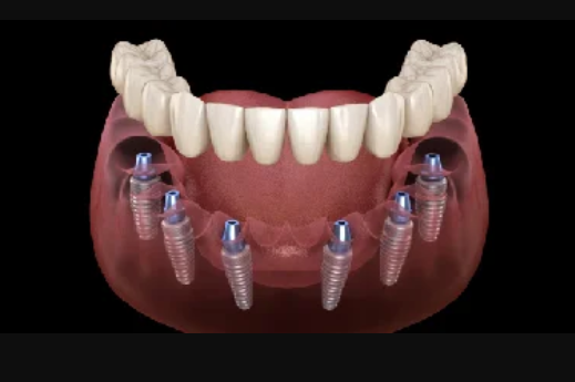 All On 6 (1 Jaw)