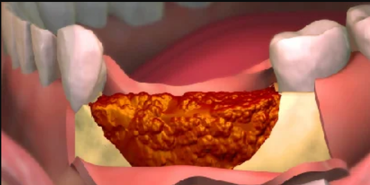 Bone Graft
