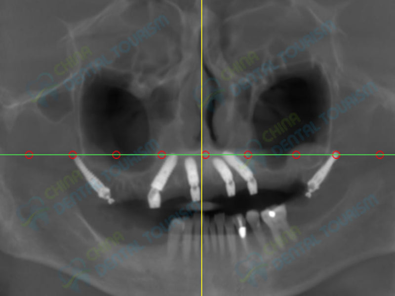 X-Ray