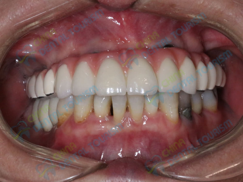 After Prosthetic