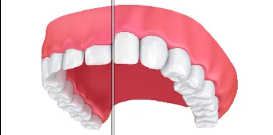Gum Contouring