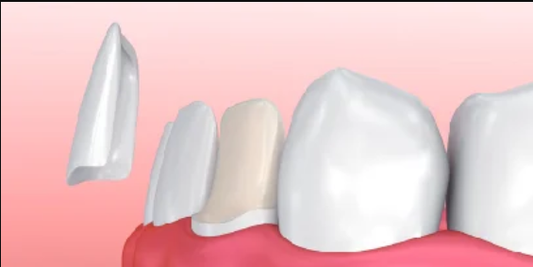Dental Veneer
