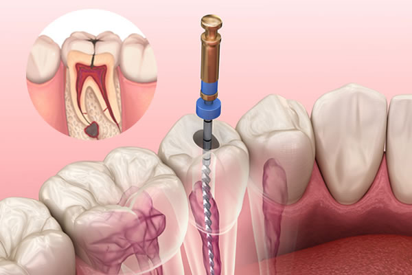 Root Canal
