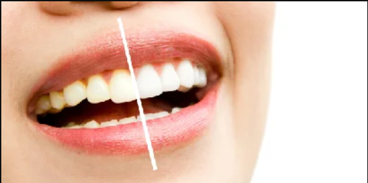 Teeth Whitening