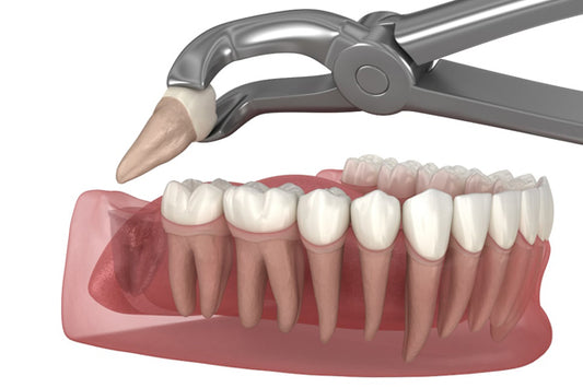 Wisdom Tooth Extraction