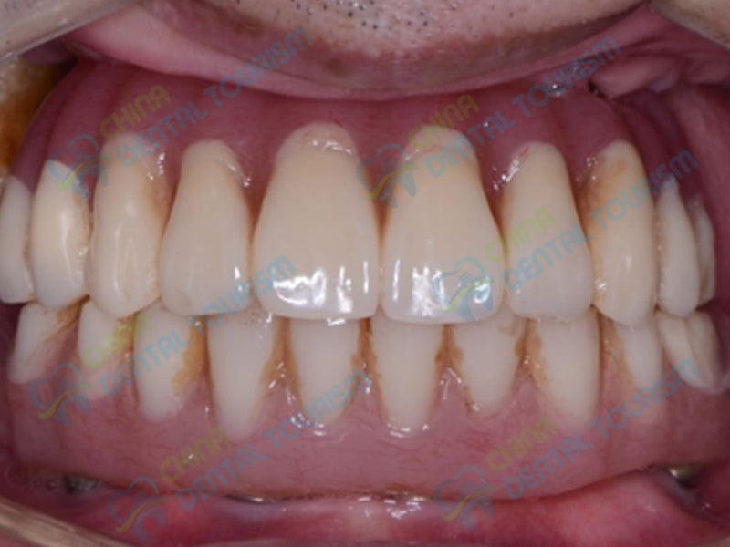 After Prosthetic