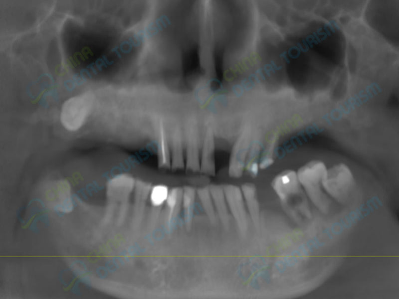 X-Ray