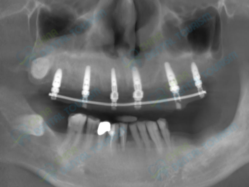 X-Ray