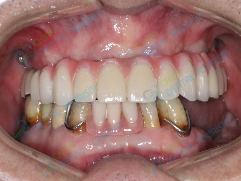 After Prosthetic