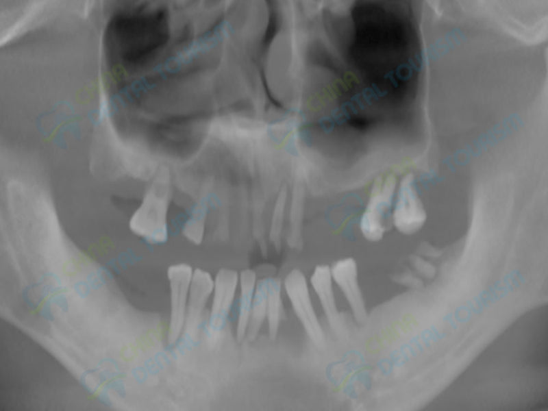 X-Ray