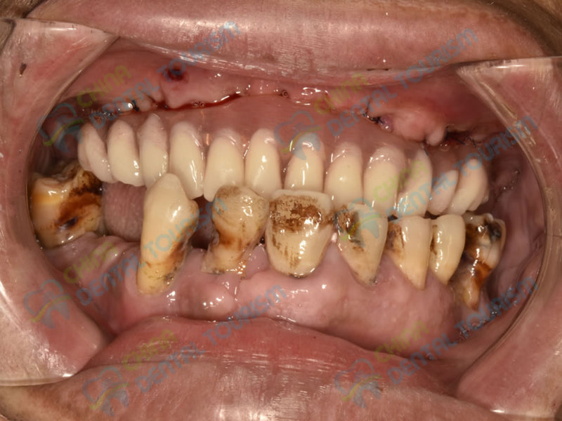 After Prosthetic