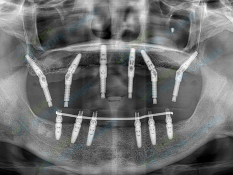 X-Ray