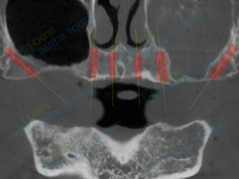 X-Ray