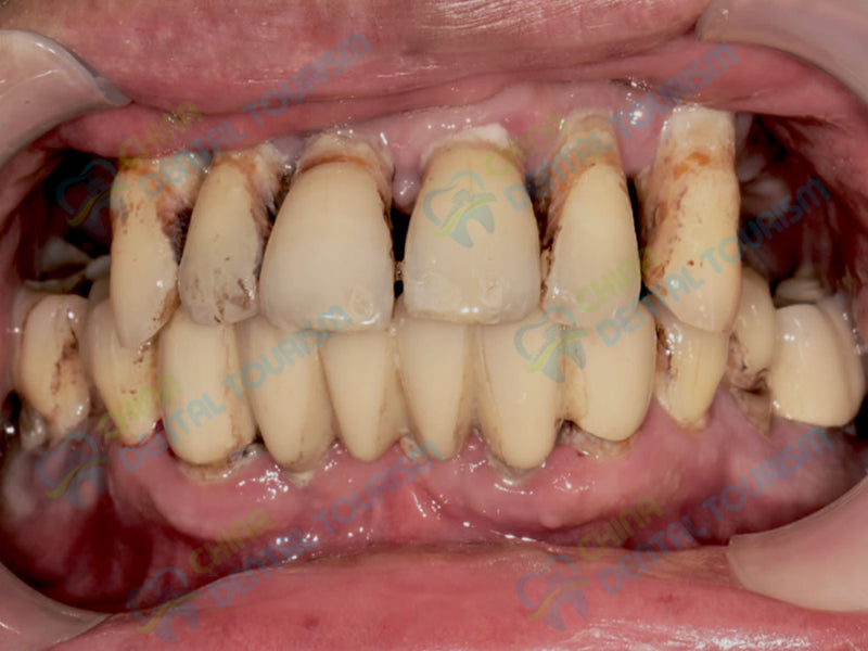 After Prosthetic