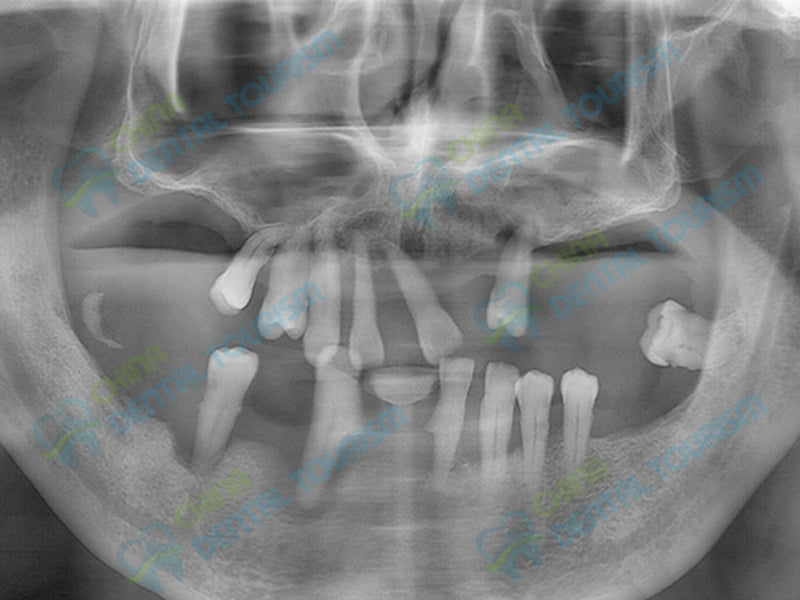 X-Ray