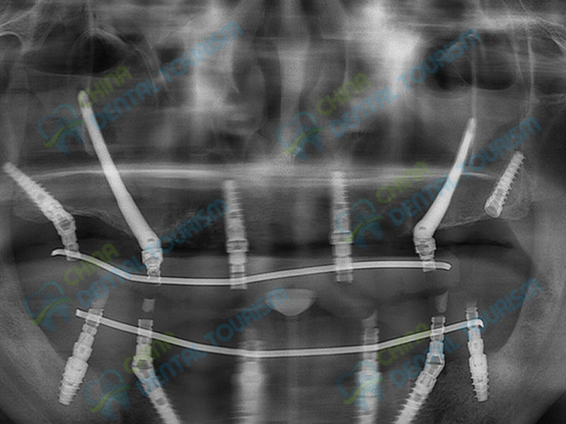 X-Ray