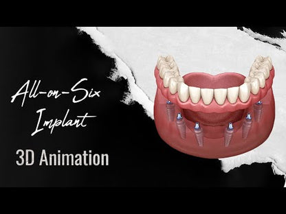 Full Mouth All-On-6 Implants Package(1 Jaws)