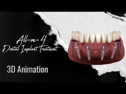 Full Mouth All-On-4 Implants Package(1 Jaws)